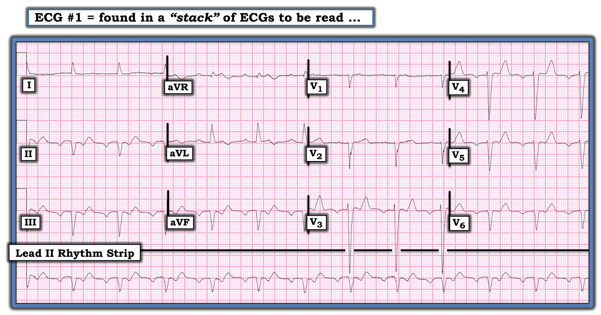 Dr. Smith's ECG Blog A Covid patient with cough and Fever. Why does