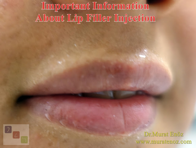 Risks of lip filler - Side effects or risks of lip filler injection - Best filler material - Risks of silicon-containing fillers - Lip augmentation with filler in Istanbul - Shaping lips with fillers - Lip enhancement with fillers in İstanbul, Turkey - Non-surgical lip augmentation - Lip augmentation and enhancement with filler - Lip filler - Lip augmentation in Istanbul - Lip augmentation (hyaluronic acid fillers) in Istanbul