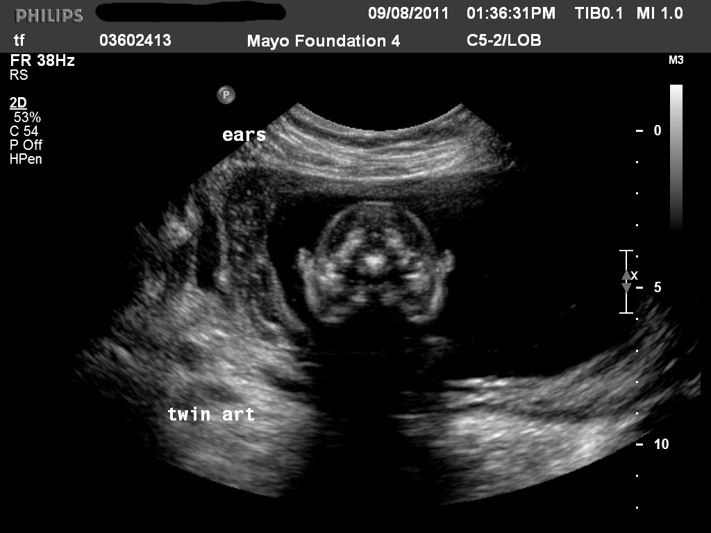 A baby for you Anatomy Ultrasound/19 weeks and 2 days/a funny story/bump picture
