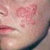 Tindakan untuk Penyakit herpes