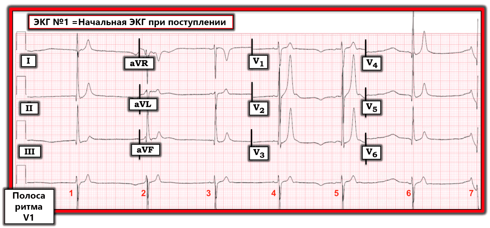 Блог по клинической электрофизиологии: О чем нужно думать при такой ...