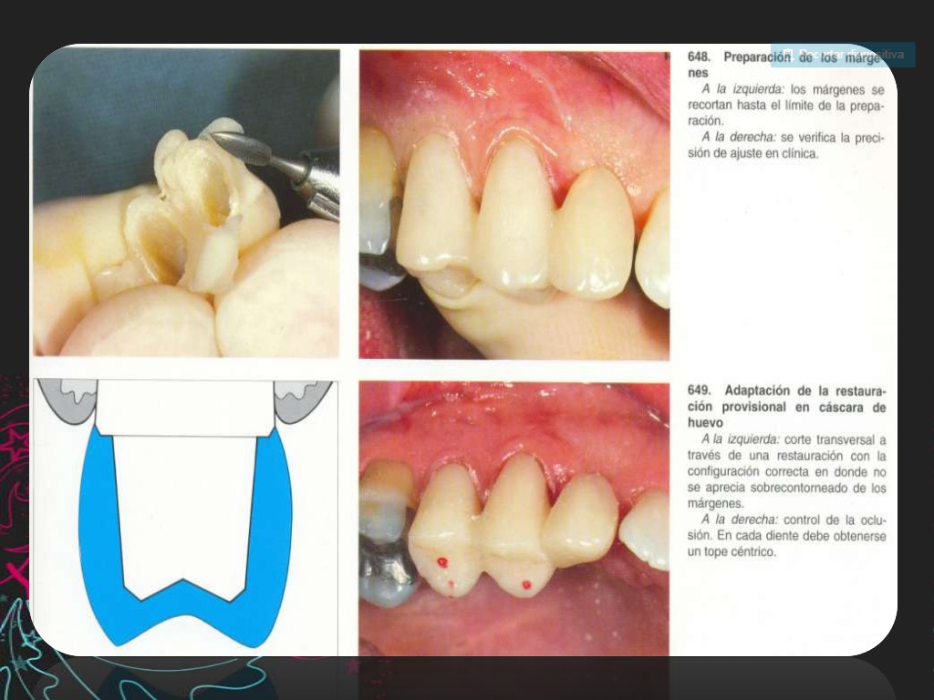 Provisionales dentales