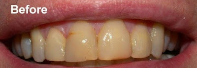 Tips Memutihkan Gigi Kuning    