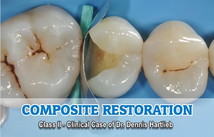 COMPOSITE RESTORATION: Class II - Clinical Case of Dr. Dennis Hartlieb