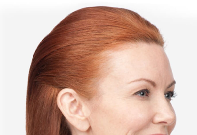 Subtle brow lift (and crow's feet treatment) botox brow lift Gold Coast