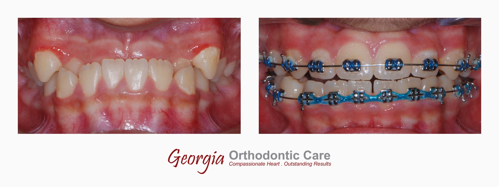 ORTHODONTIC CARE LAWRENCEVILLE & NORCROSS GA December 2014