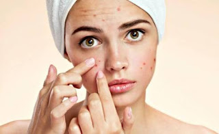 what causes acne breakouts