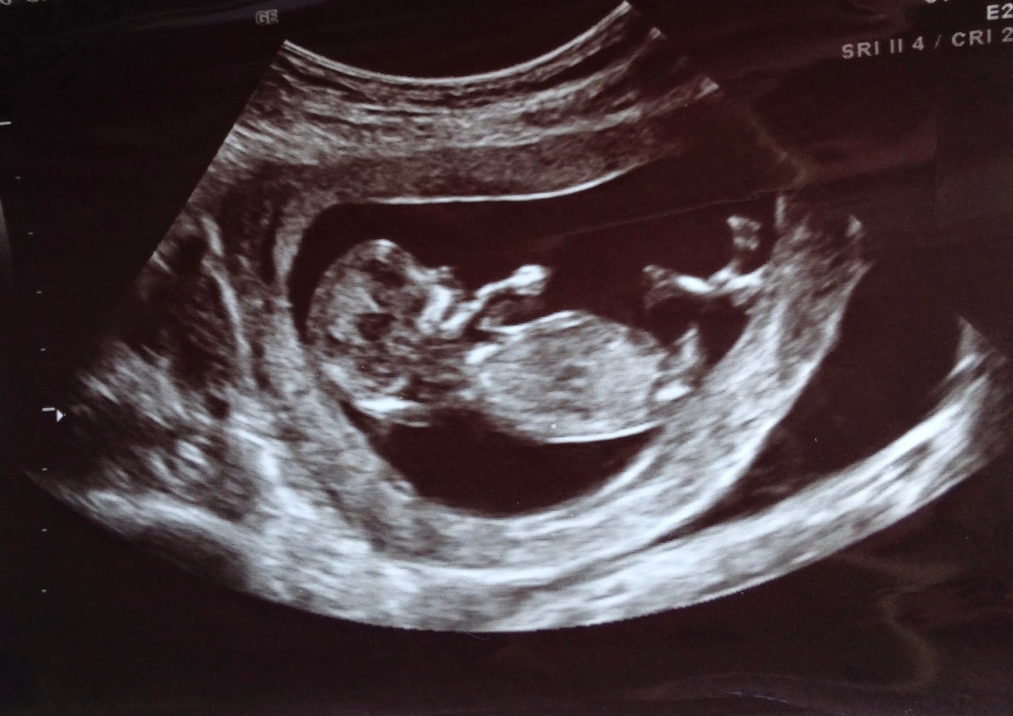 zack-sydney-12-week-ultrasound