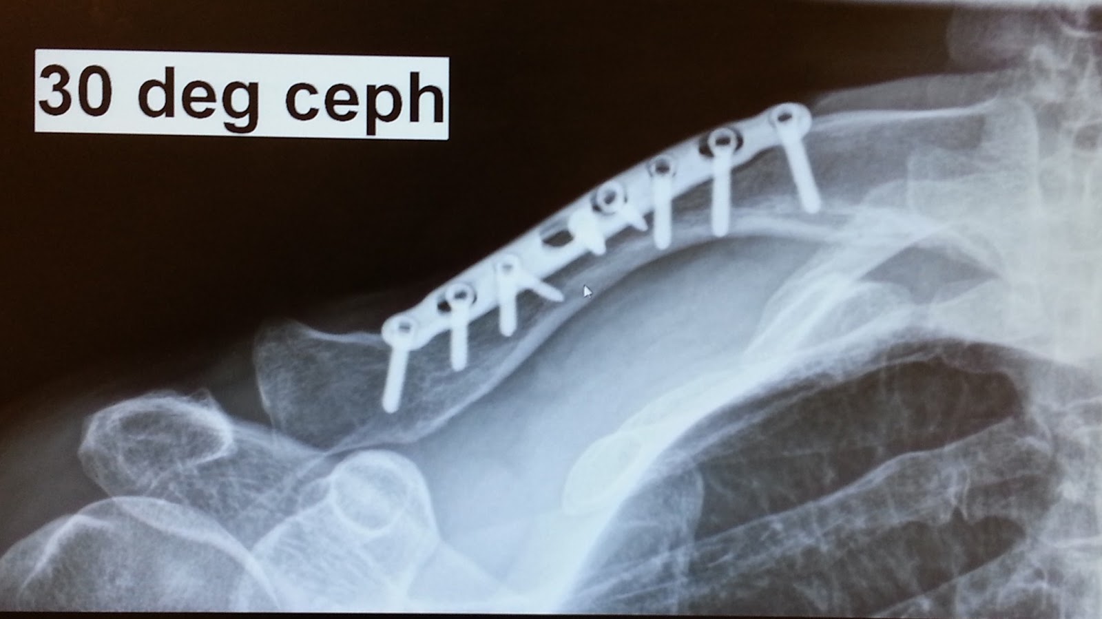 Mike McQuaide BROKEN COLLARBONE UPDATE, ALMOST 3 YEARS LATER