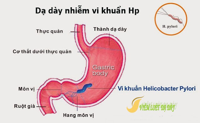 cac benh ly thuong gap o da day can biet các bệnh lý thường gặp ở dạ dày cần biết