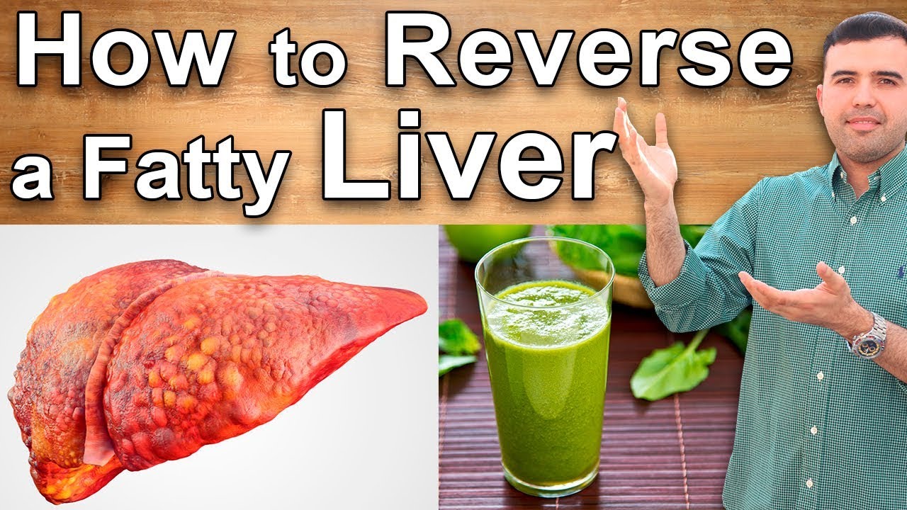 Fatty Liver Grade 3 Fatty Liver Remedy