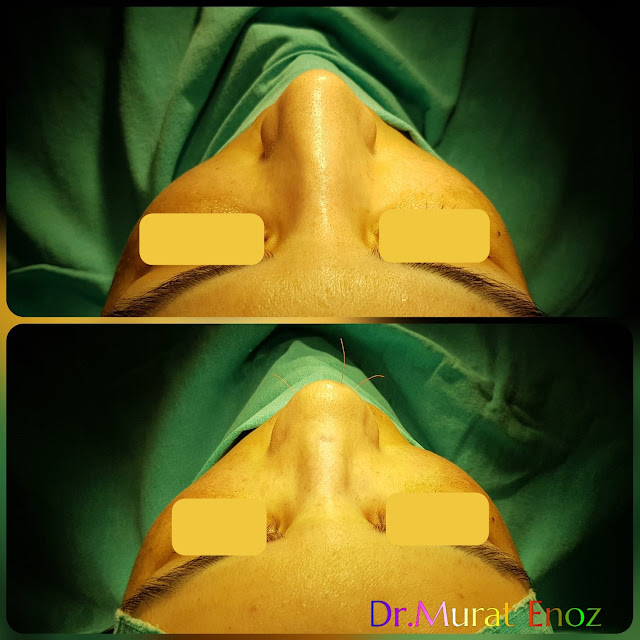 Rhinoplasty 1 month vs 5 Months,Rhinoplasty in Women Istanbul,Female Nose Job,
