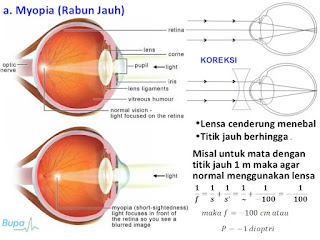Lensa Mata Rabun Jauh – Bagis