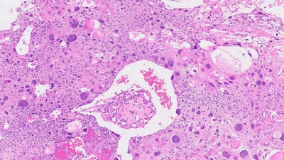 Pathologic Staging,  Histopathology and Cervical Cancer Screening