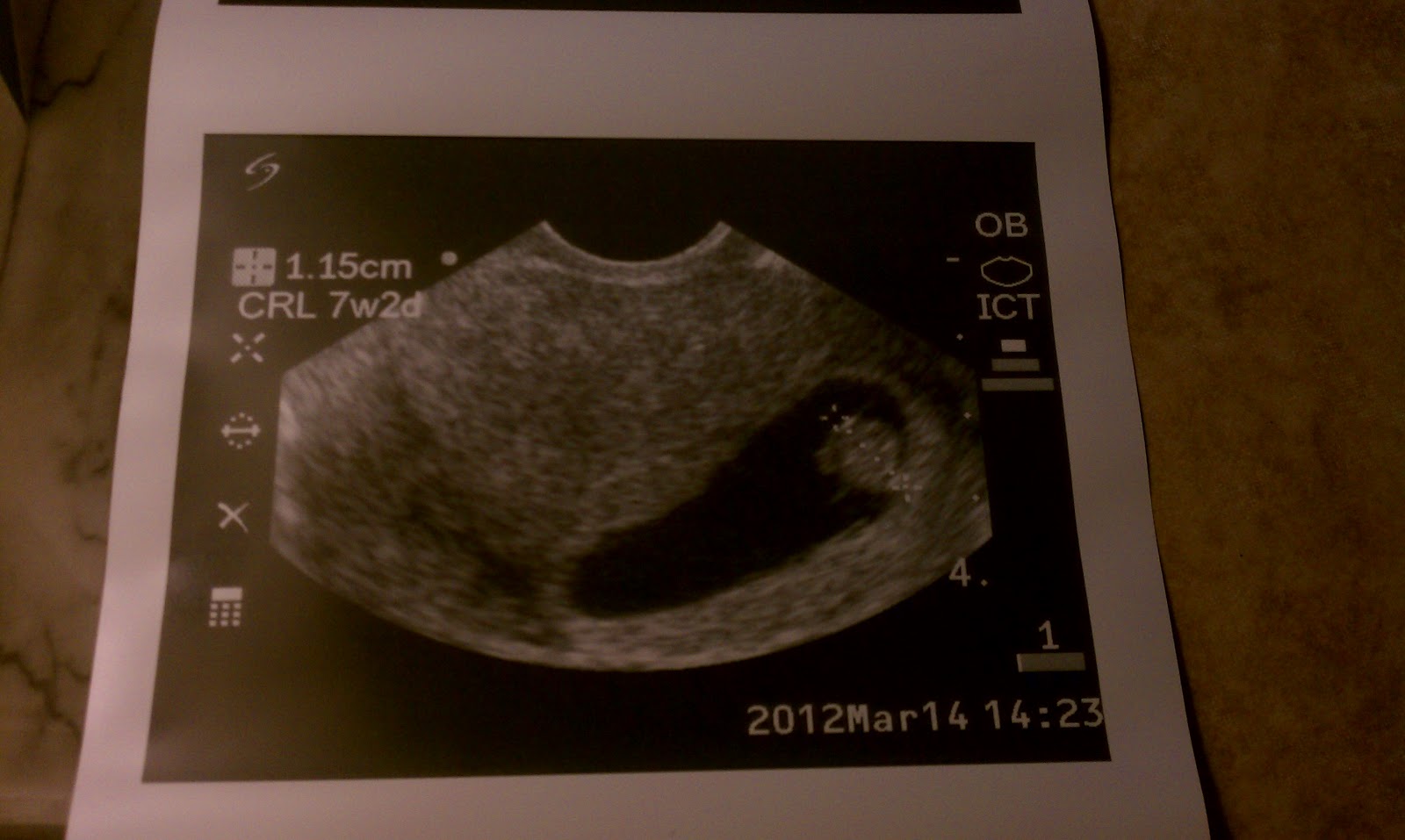 baby no heartbeat at 6 weeks baby no heartbeat at 6 weeks