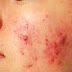 Recognize the Causes Of Acne, Symptoms, And Treatment