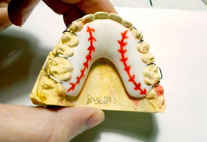 ORTHODONTICS: How to make a Baseball Themed Retainer