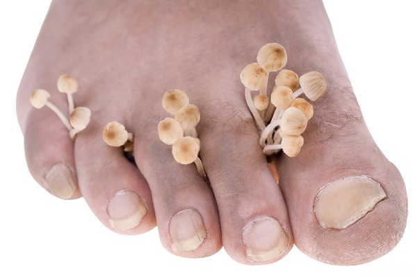 Toe Fungus Natural Cure - Can Home Ingredients Cure Toe Nail Fungus? Toe Fungus Natural Cure - Can Home Ingredients Cure Toe Nail Fungus?