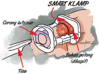 Berkhatan Guna Kaedah Smart Clamp Ismail