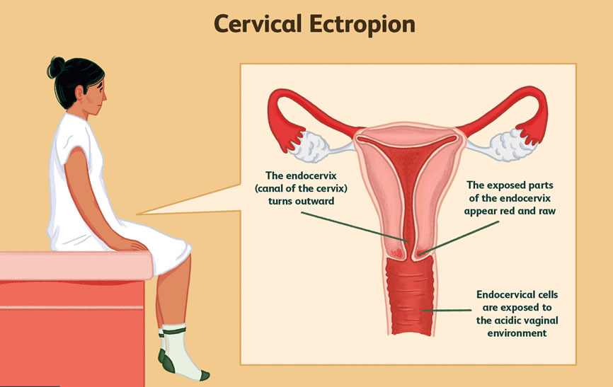 Health Zone Turkey What Is A Wound In The Cervix Servical Erosion How Is It Treated