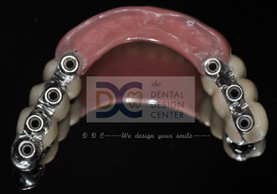 Full mouth implants in severe maxillary resorbed ridge 35 Screen%2BShot%2B2560 02 02%2Bat%2B6.56.31%2BAM