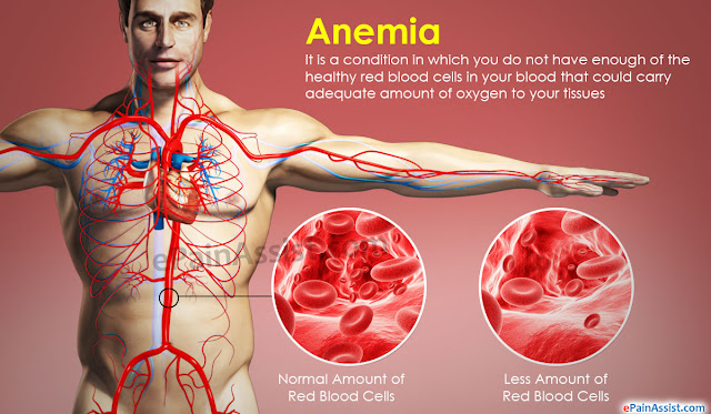 Bahaya Penyakit Anemia