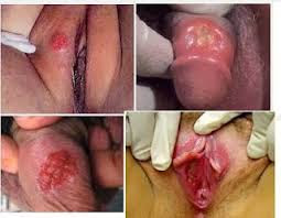 ciri-ciri penis terkena sipilis ciri-ciri penis terkena sipilis
