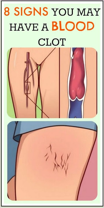 8 Signs You May Have A Blood Clot