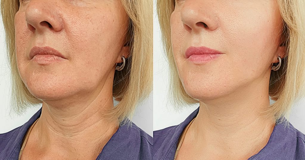 Recette De Masque La Ma zena Avec Effet Botox Pour Les Femmes De 30 recette-de-masque-la-ma-zena-avec-effet-botox-pour-les-femmes-de-30