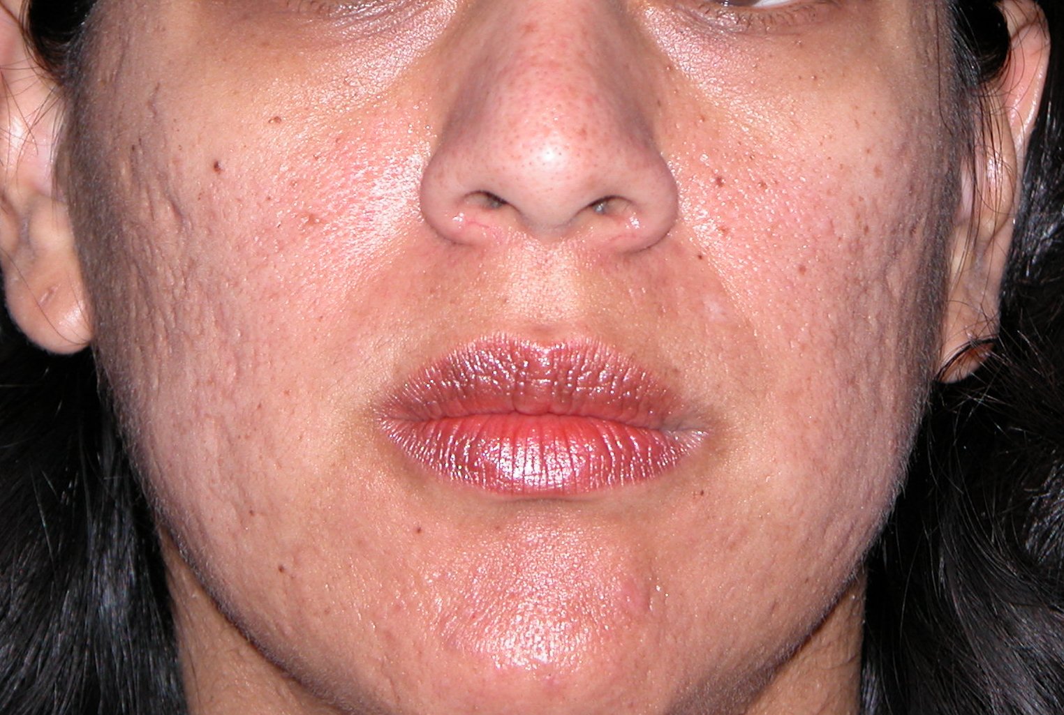 Acne scarring | Acne Academy