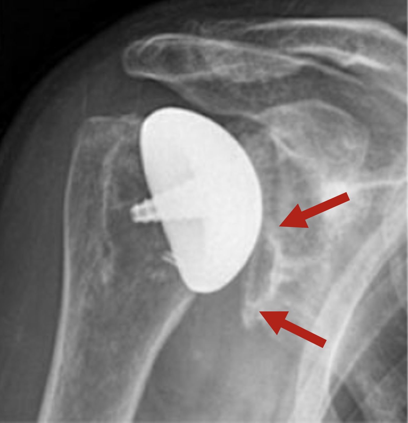 UW Shoulder and Elbow Academy The inlay glenoid arthroplasty in weight