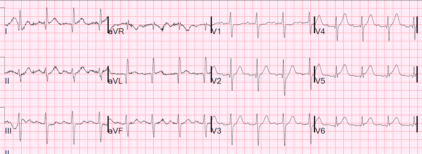 Dr. Smith's ECG Blog Ten cases of hyperacute Twaves in V4V6 Dr. Smith's ECG Blog Ten cases of hyperacute Twaves in V4V6