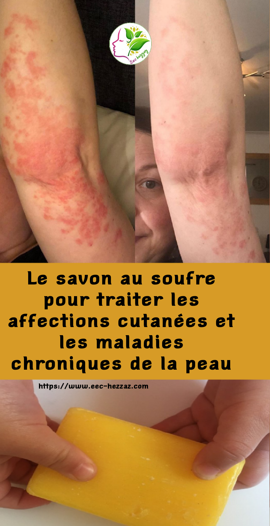 Le savon au soufre pour traiter les affections cutanées et les maladies chroniques de la peau