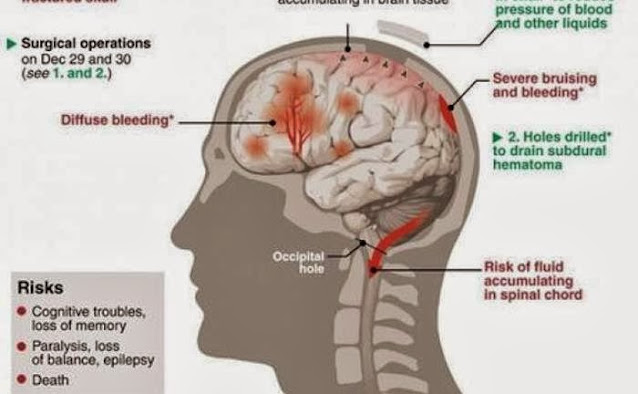 Ο Σουμάχερ τραυματίζεται το 2013