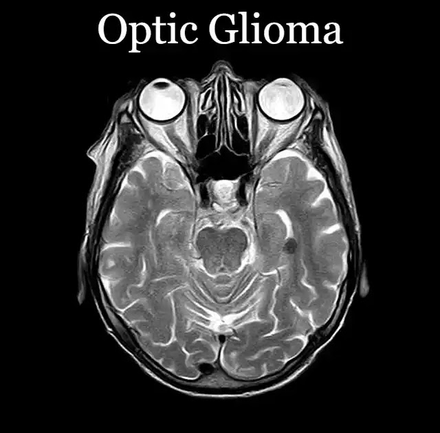 Optic Glioma