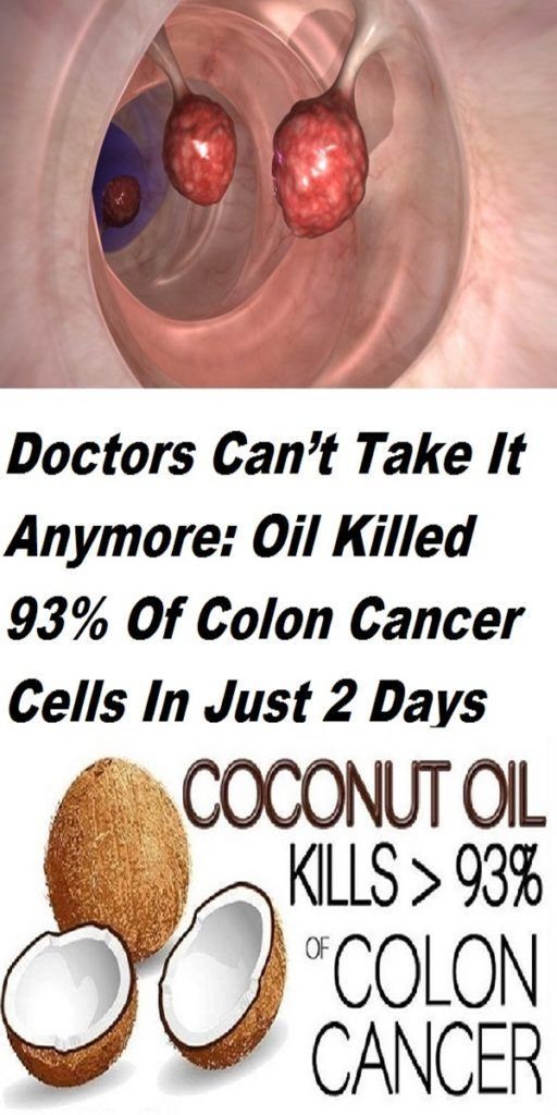 Even The Doctors Are Shocked Coconut Oil Kills 93 Of Colon Cancer