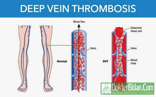 Deep Vein Thrombosis (DVT) Trombosis Vena - Gejala Penyebab Dan Obat Alami Tradisional Yang Ampuh di Apotik Deep Vein Thrombosis (DVT) Trombosis Vena - Gejala Penyebab Dan Obat Alami Tradisional Yang Ampuh di Apotik