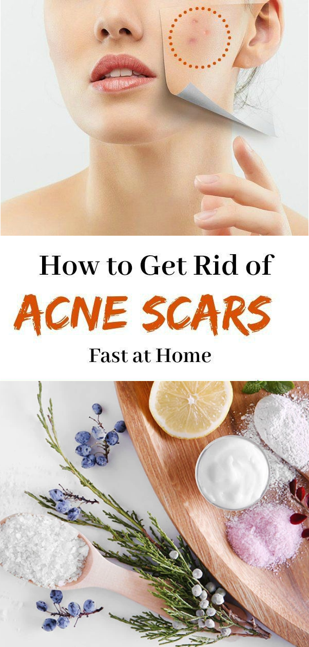 Get Rid of Acne Marks Using Homemade Remedies Healthy Lifestyle