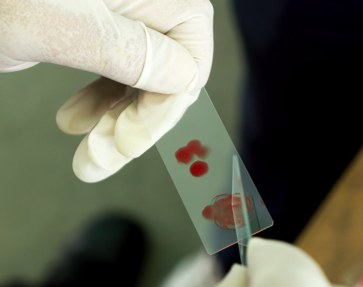 Для диагностики малярии забор крови осуществляют. Микроскопия толстой капли крови. Исследование на малярию. Предметные стекла в крови. Исследование толстой капли крови.