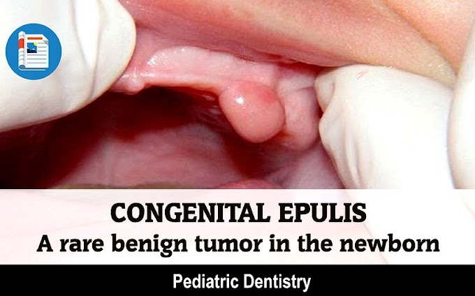 CONGENITAL EPULIS: A rare benign tumor in the newborn
