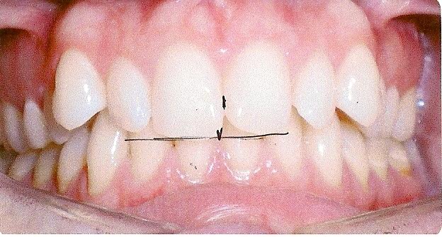 teeth each molars correctly lined line bottom supposed together sit between properly another welcome
