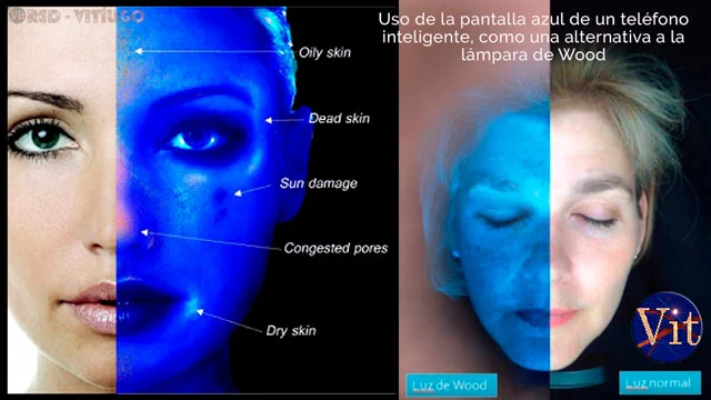 Diagnóstico del Vitiligo con un Smartphone o Teléfono Inteligente