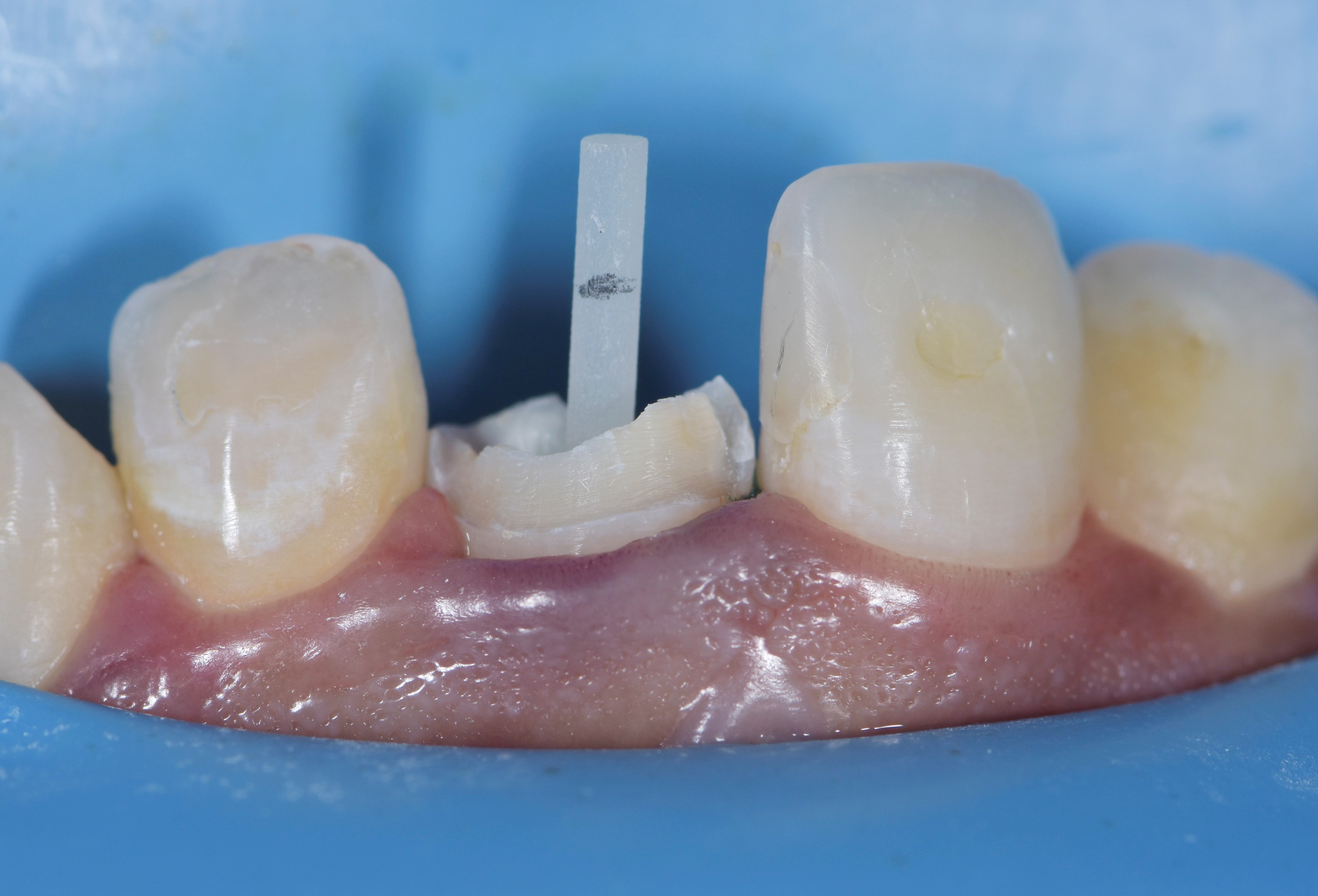 Inverse injection of composite over a fiber post Dental Esthetics