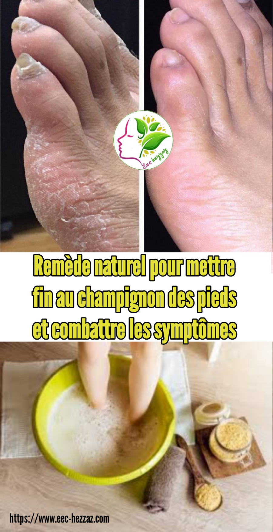 Remède naturel pour mettre fin au champignon des pieds et combattre les