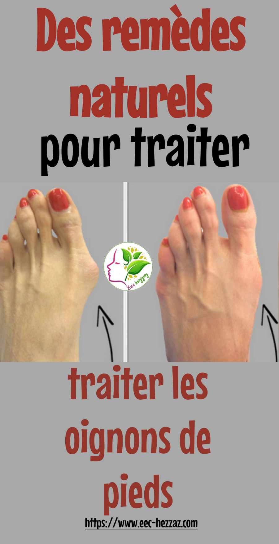 Des remèdes naturels pour traiter les oignons de pieds