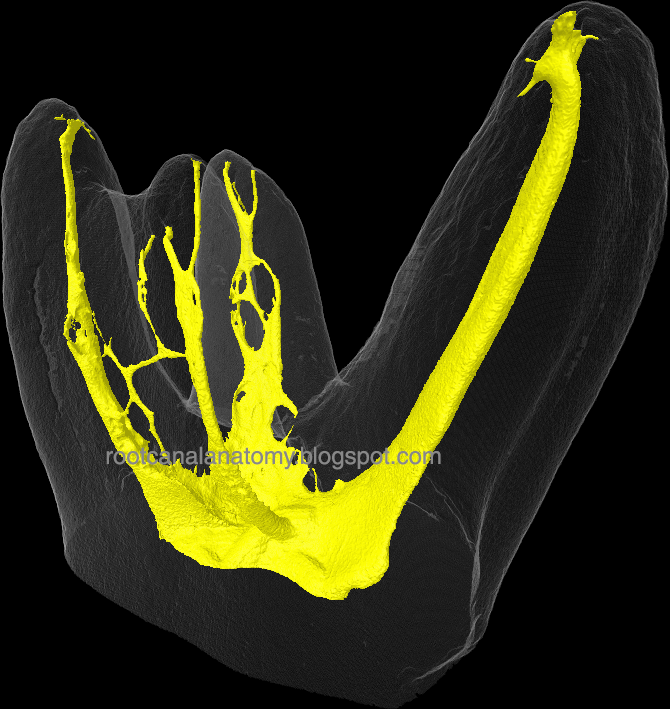 The Root Canal Anatomy Project: MB3 Canal [Maxillary First Molar]
