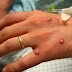 US CDC Detects First Case of Monkeypox “Imported" from Nigeria