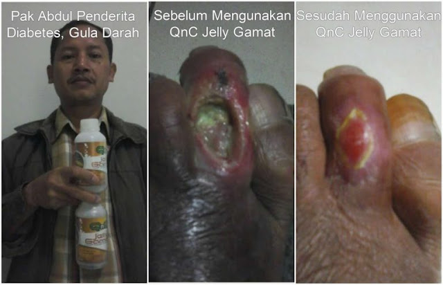Cara Mengobati Luka Diabetes Basah Secara Alami Terbukti Mujarab ~ Testimoni QNC JELLY GAMAT Cara Mengobati Luka Diabetes Basah Secara Alami Terbukti Mujarab ~ Testimoni QNC JELLY GAMAT