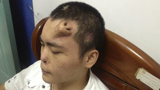 Chinese Man Has New Nose Grown on His Forehead
