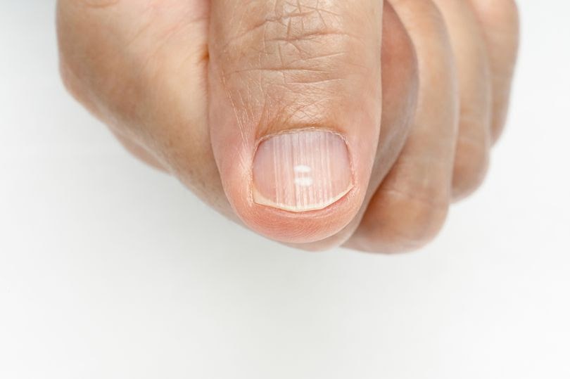 Health Problems Your Fingernails Can Indicate From White Spots To Ridges
